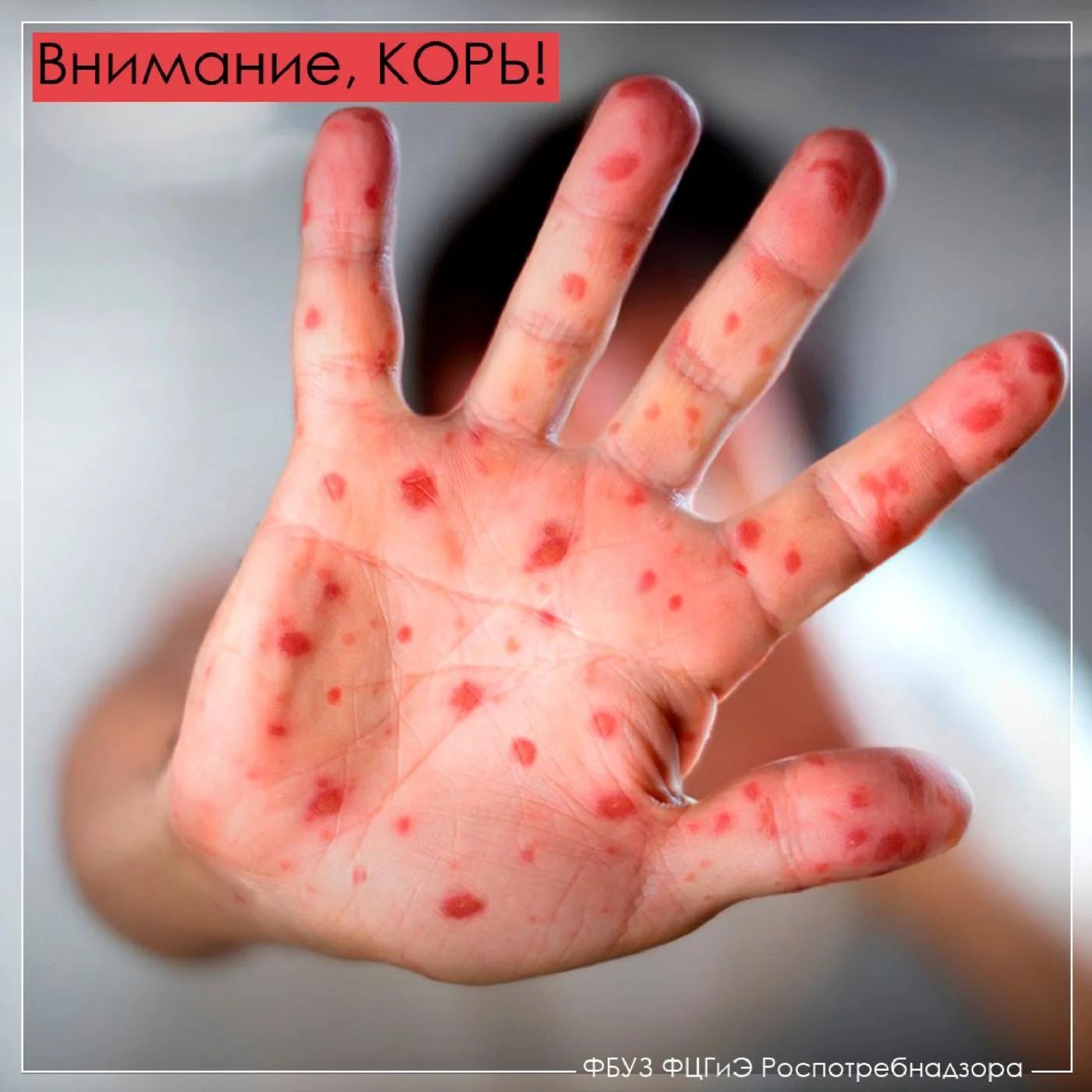 Как проявляется корь и как от нее защитится?