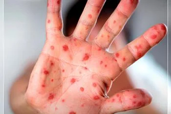 Как проявляется корь и как от нее защитится?